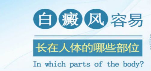 节段型白癜风的症状表现有哪些?